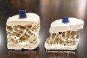 91免费看片测量仪测出骨质疏松怎么办