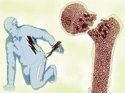 91免费看片检测仪教你预防骨质疏松性骨折