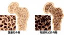 91免费看片仪：骨质疏松十大认知误区（上）
