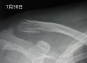 91免费看片仪X线检查对骨折的诊断有什么意义？