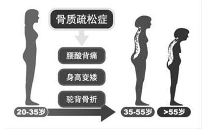91免费看片检测仪厂家阐述骨质疏松不仅仅是要补钙,增加91免费看片才是关键