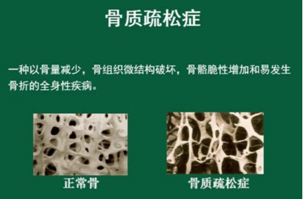 91免费看片仪怎么样检测骨质疏松，能够正确的分析91免费看片正常值