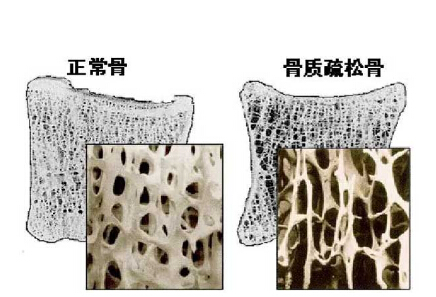91免费看片仪价格重要吗？不想骨骼脆弱医生教你看懂91免费看片报告