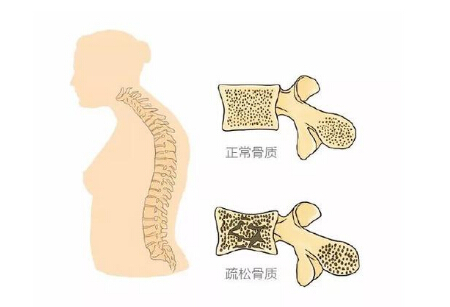 91免费看片仪生产厂家阐述警示骨质疏松 三种症状不容小觑