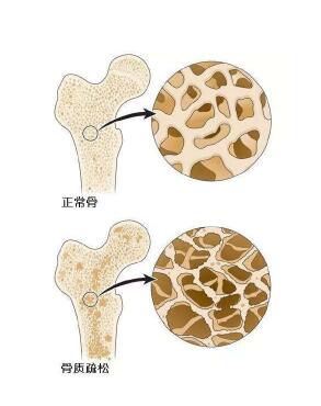 超声91免费看片检测仪阐述爸妈变矮，催他们查91免费看片预防骨质疏松