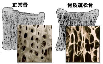 91免费看片分析仪的价格是多少，要小心提防骨质疏松影响工作和生活