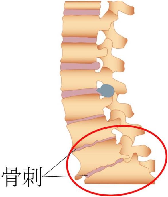 吉林长春|91看片在线下载安装超声91免费看片仪厂家品牌分享:为什么现在的年轻人也存在骨刺增生?
